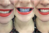 Can purple food coloring whiten teeth